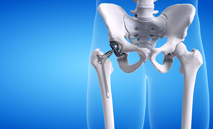 Hip Surgery