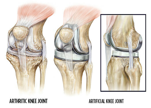 Knee Surgery